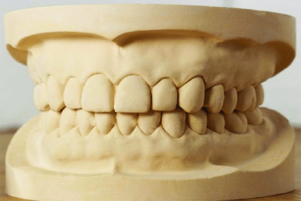 Lấy dấu răng bằng thạch cao là phương pháp không còn phổ biến để lấy dấu trực tiếp