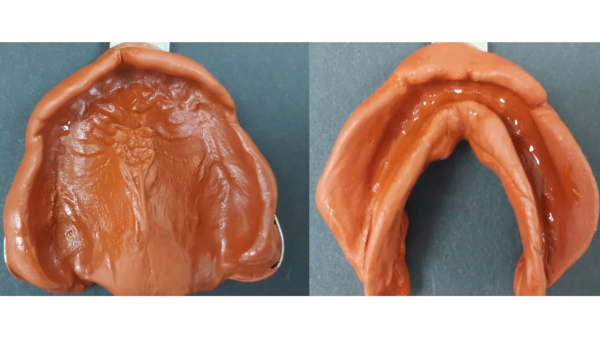 Lấy dấu răng bằng hợp chất dẻo hỗ trợ lấy dấu răng nhiều phân đoạn