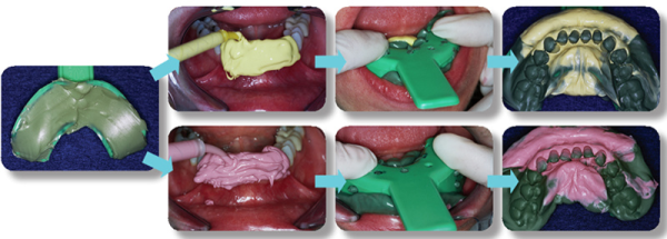 Phương pháp lấy dấu 2 thì