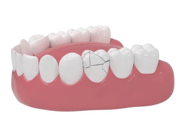 Mài răng bọc sứ: Quy trình, rủi ro và địa chỉ uy tín 5 Rủi ro khi bọc răng sứ kém chất lượng khiến mão sứ dễ nứt vỡ, giảm tuổi thọ sử dụng