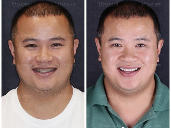 Mài răng bọc sứ: Quy trình, rủi ro và địa chỉ uy tín 7 Platinum Dental – Địa chỉ uy tín mài răng bọc sứ, vật liệu chính hãng, bảo hành minh bạch. Kết quả đảm bảo thẩm mỹ tự nhiên, khớp cắn ổn định, bền vững