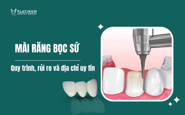 mài răng bọc sứ