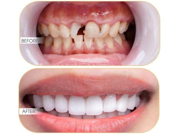 Mài răng bọc sứ: Quy trình, rủi ro và địa chỉ uy tín 1 Người có răng sứt, mẻ cân nhắc bọc răng sứ để đảm bảo thẩm mỹ, bảo tồn răng thật tối đa