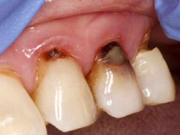 Mất chân răng là gì? Nguyên nhân, hậu quả và cách khắc phục hiệu quả 2 Chân răng bị mục có thể là nguyên nhân gây mất chân răng