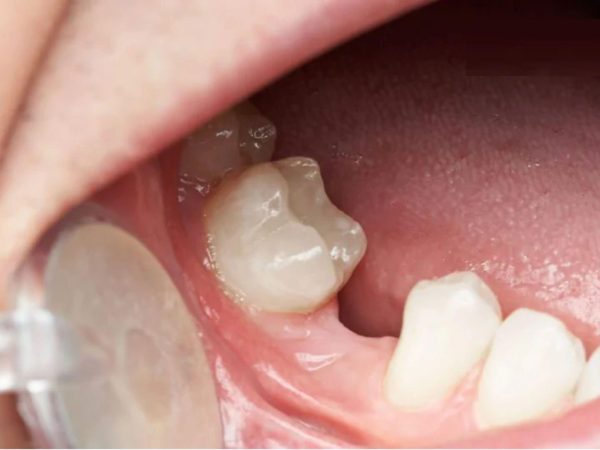 Mất chân răng là gì? Nguyên nhân, hậu quả và cách khắc phục hiệu quả 1 Mất chân răng là tình trạng phần chân răng bị tổn thương, tiêu biến hoặc buộc phải loại bỏ