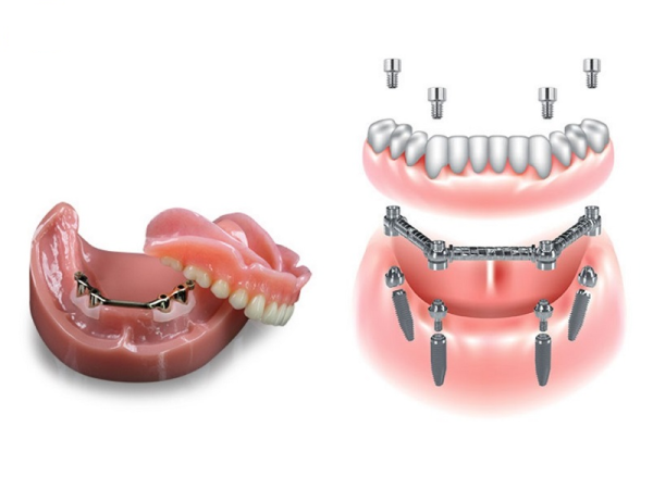 Hàm phủ/ghép trên implant là giải pháp kết hợp giữa hàm giả tháo lắp và trụ Implant