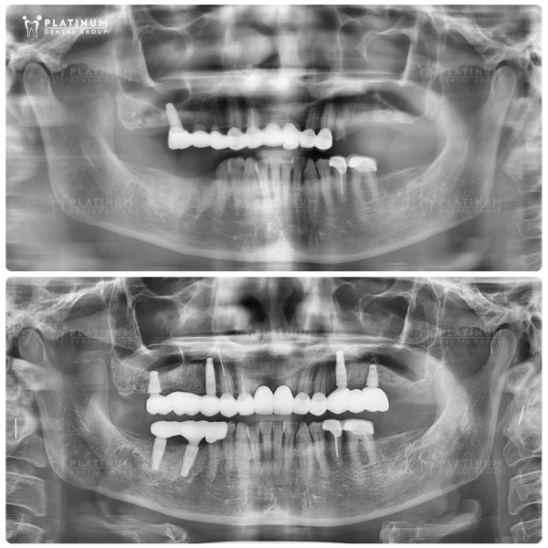 Kỹ thuật này cho phép cố định toàn hàm răng chỉ với 4–6 trụ Implant, giảm xâm lấn, tiết kiệm chi phí và đặc biệt phù hợp với bệnh nhân tiêu xương lâu năm