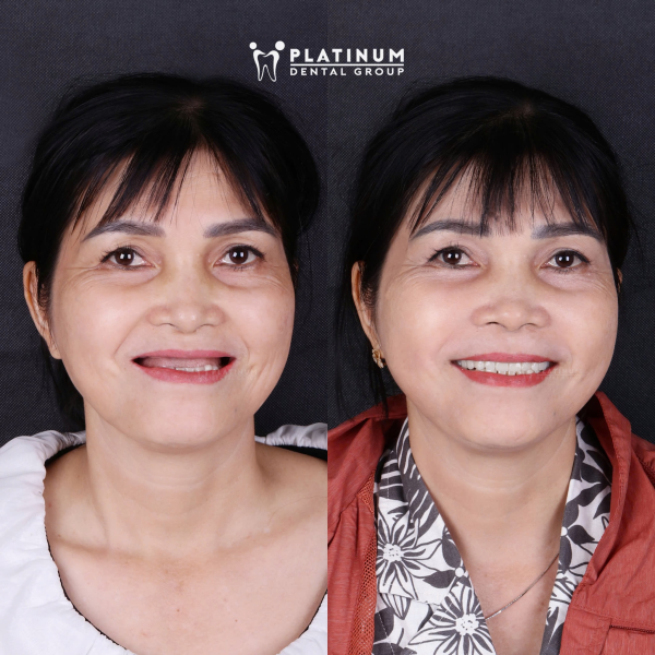 Mất răng toàn hàm lâu gây ra tình trạng tiêu xương hàm khiến vùng miệng bị hóp lại (hình bên trái - tình trạng ban đầu trước khi trồng răng Implant toàn hàm)