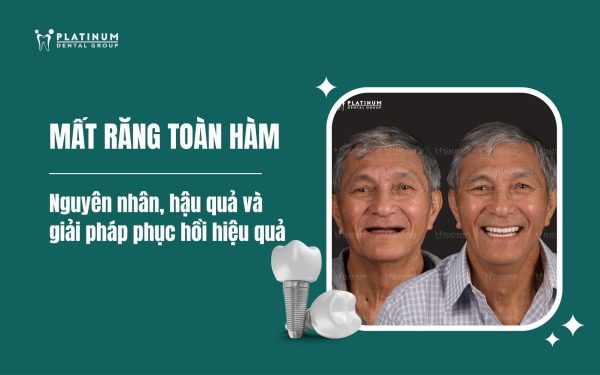 Mất răng toàn hàm