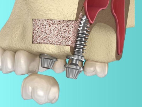 Nâng xoang hở được chỉ định khi tình trạng xương hàm trên không đủ điều kiện để cấy Implant