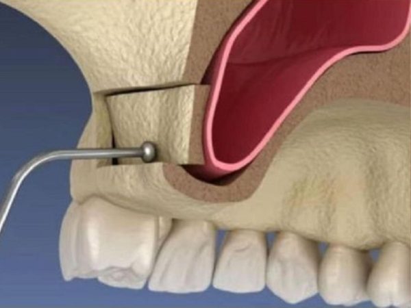 Chi phí nâng xoang hở bao nhiêu?