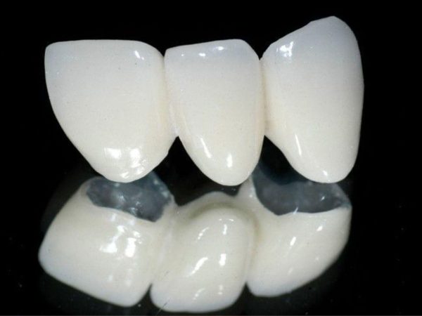 Góc thắc mắc: Nên bọc răng sứ kim loại hay titan? 2 Răng sứ titan là loại răng sứ có khung sườn bằng kim loại titan, bên ngoài được bọc lớp sứ trắng