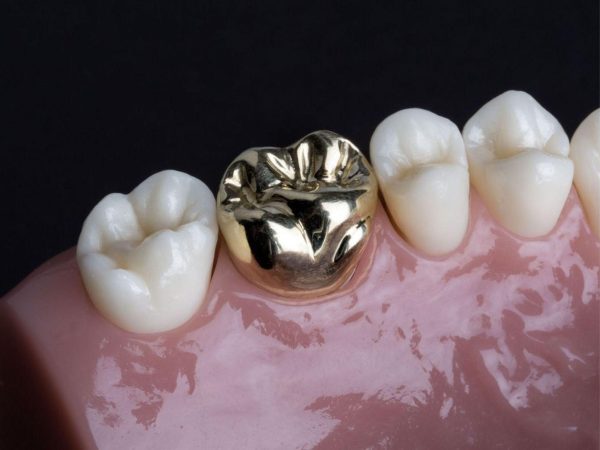 Góc thắc mắc: Nên bọc răng sứ kim loại hay titan? 1 Răng sứ kim loại là loại răng được chế tác hoàn toàn từ kim loại