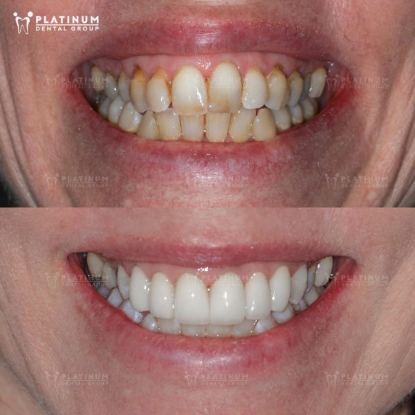 Góc thắc mắc: Nên bọc răng sứ kim loại hay titan? 4 Bọc răng sứ titan có tính thẩm mỹ cao hơn