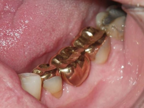 Góc thắc mắc: Nên bọc răng sứ kim loại hay titan? 3 Răng sứ kim loại phù hợp bọc răng hàm với chi phí thấp hơn