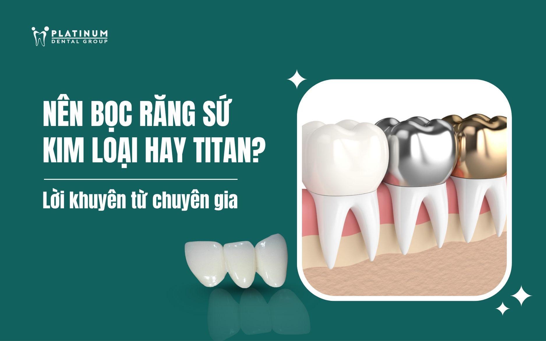 nên bọc răng sứ kim loại hay titan