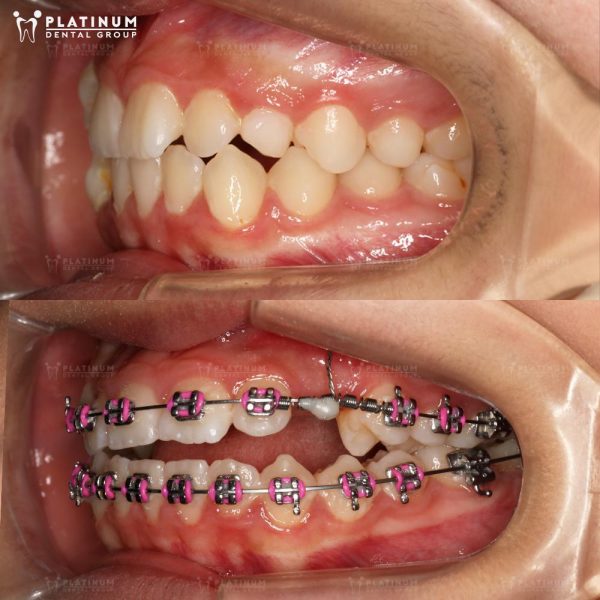 Trồng răng Implant hoặc chỉnh nha để ngăn tiêu xương hàm sau nhổ răng số 4