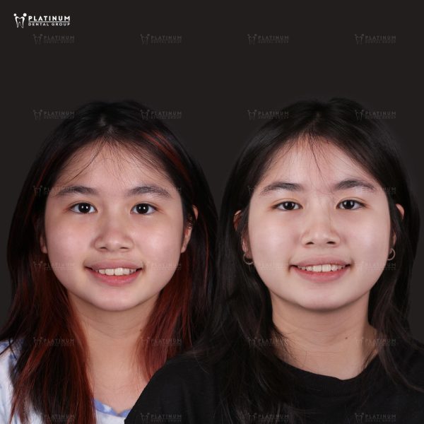 Sai lệch khớp cắn, răng lệch lạc khi mất răng số 4 mà không phục hồi răng đã mất sớm