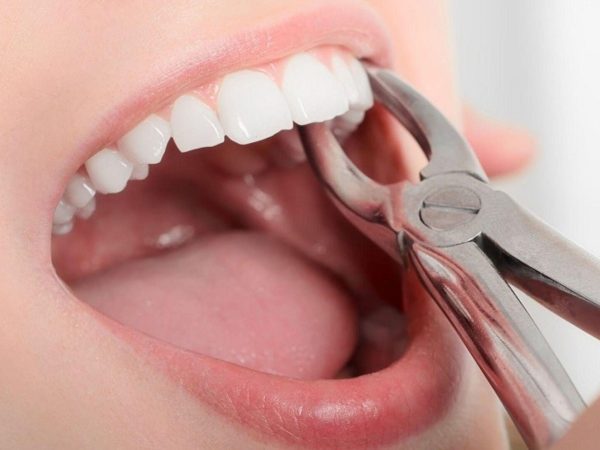 Việc nhổ răng số 4 chỉ được thực hiện khi thực sự cần thiết