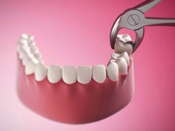 Nhổ răng số 6 có nguy hiểm không?