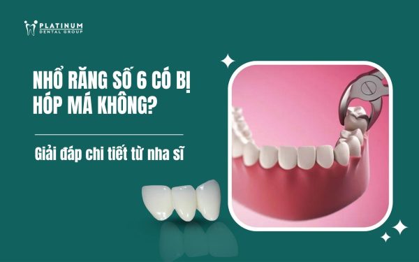 nhổ răng số 6 có bị hóp má không