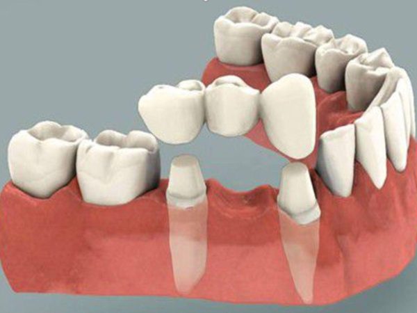 Cầu răng sứ là phương pháp phục hồi răng đã mất truyền thống