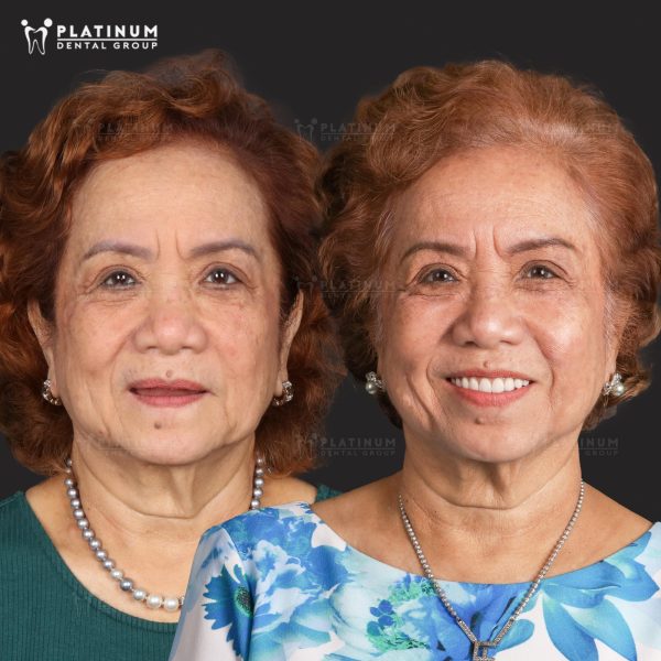 Cùng xem các khách hàng trồng răng Implant tại Platinum Dental Group
