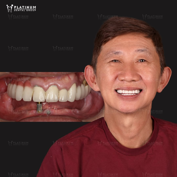 Chú V. đã lấy lại nụ cười rạng rỡ và khả năng ăn nhai thoải mái