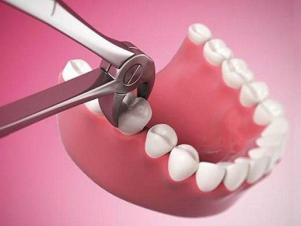 Xác định thời điểm nhổ răng vĩnh viễn: Bảo tồn răng thật hay nhổ để bảo vệ sức khỏe răng miệng?