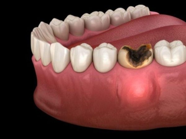 Nhổ răng an toàn theo chuẩn y khoa sẽ giúp giảm thiểu nguy cơ bị nhiễm trùng nguy hiểm