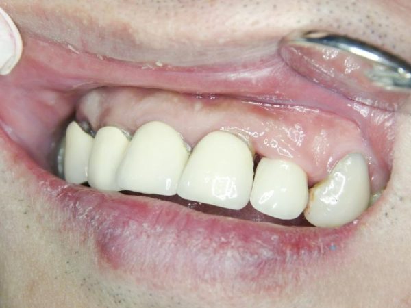 Nhược điểm của việc bọc răng sứ: Lưu ý quan trọng trước khi làm 3 Bọc răng sứ giá rẻ tiềm ẩn nhiều rủi ro như bong tróc, nứt gãy