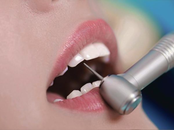 Nhược điểm của việc bọc răng sứ: Lưu ý quan trọng trước khi làm 1 Nhược điểm lớn nhất của bọc răng sứ là phải mài răng thật, có nguy cơ ảnh hưởng men răng