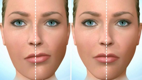 Phẫu thuật gọt hàm phù hợp với những người có hàm bị lệch, không cân xứng