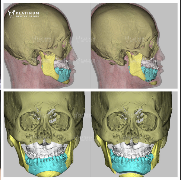 Phẫu thuật chỉnh xương hàm (Orthognathic Surgery)