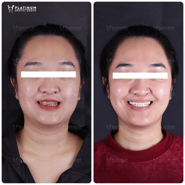 Phẫu thuật hàm được chỉ định với bệnh nhân bị lệch mặt, dị tật hàm ếch