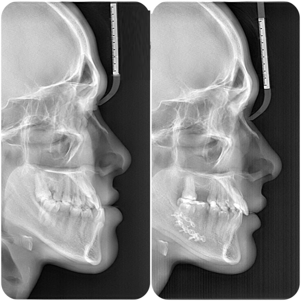 Phẫu thuật hàm móm là một thủ thuật can thiệp xương hàm có mức độ phức tạp cao