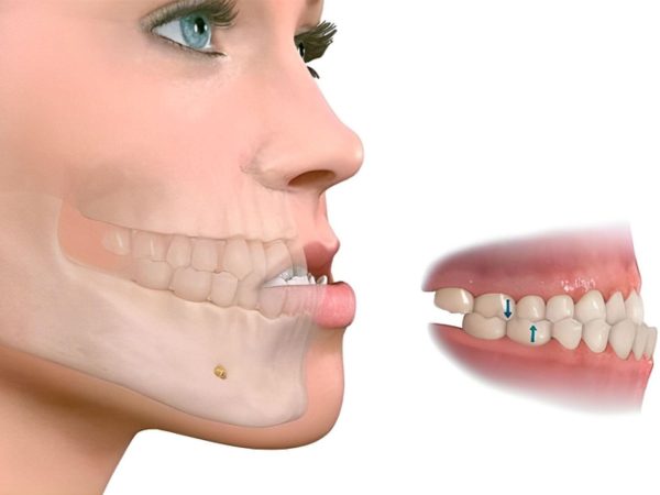 Phẫu thuật hàm móm là gì?