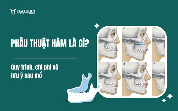 phẫu thuật hàm