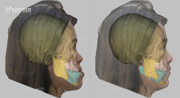 Phẫu thuật xương hàm giúp khôi phục khớp cắn và cải thiện thẩm mỹ