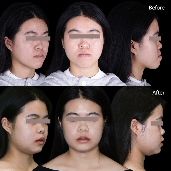 Sau 3 đến 6 tháng phẫu thuật xương hàm đã lành hoàn toàn