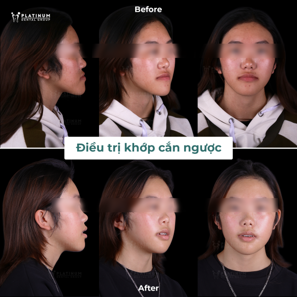 Khách hàng được chăm sóc tại Platinum Dental Group sau khi phẫu thuật xương hàm