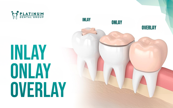 Discover the safe porcelain teeth making process at Platinum Dental Group 3 Illustration of fixed dental restorations: Inlay, Onlay, Overlay