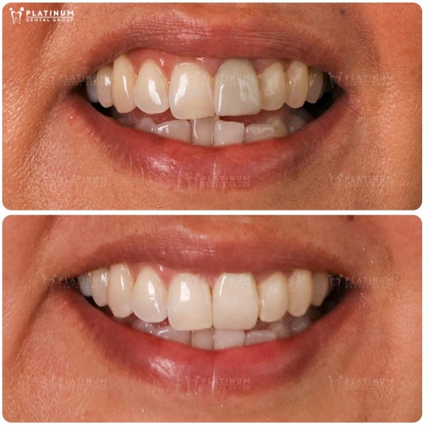 Discover the safe porcelain teeth making process at Platinum Dental Group 2 Porcelain crowns are indicated to improve the overall shape and uniformity of the smile