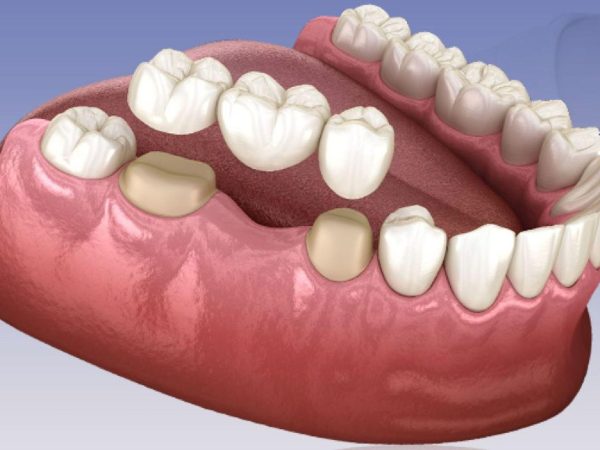 Discover the safe porcelain teeth making process at Platinum Dental Group 5 A porcelain bridge is utilized to replace missing teeth