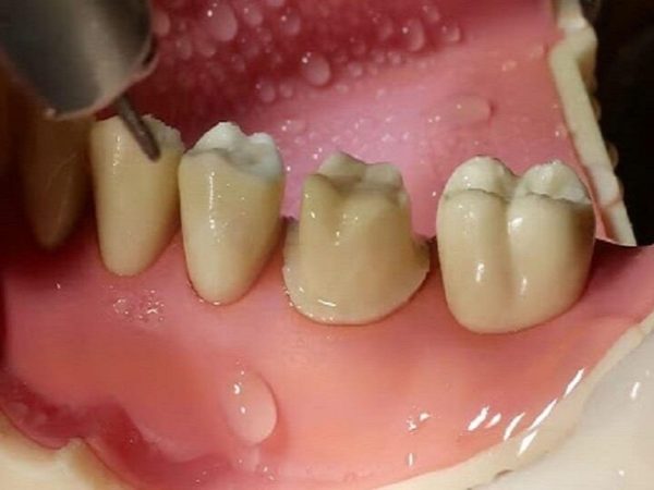 Răng bọc sứ bị viêm tủy: Nguyên nhân, dấu hiệu và cách xử lý hiệu quả 2 Mài cùi răng quá sâu, sát tuỷ cũng có thể là nguyên nhân gây ra tình trạng bọc răng sứ bị viêm tuỷ