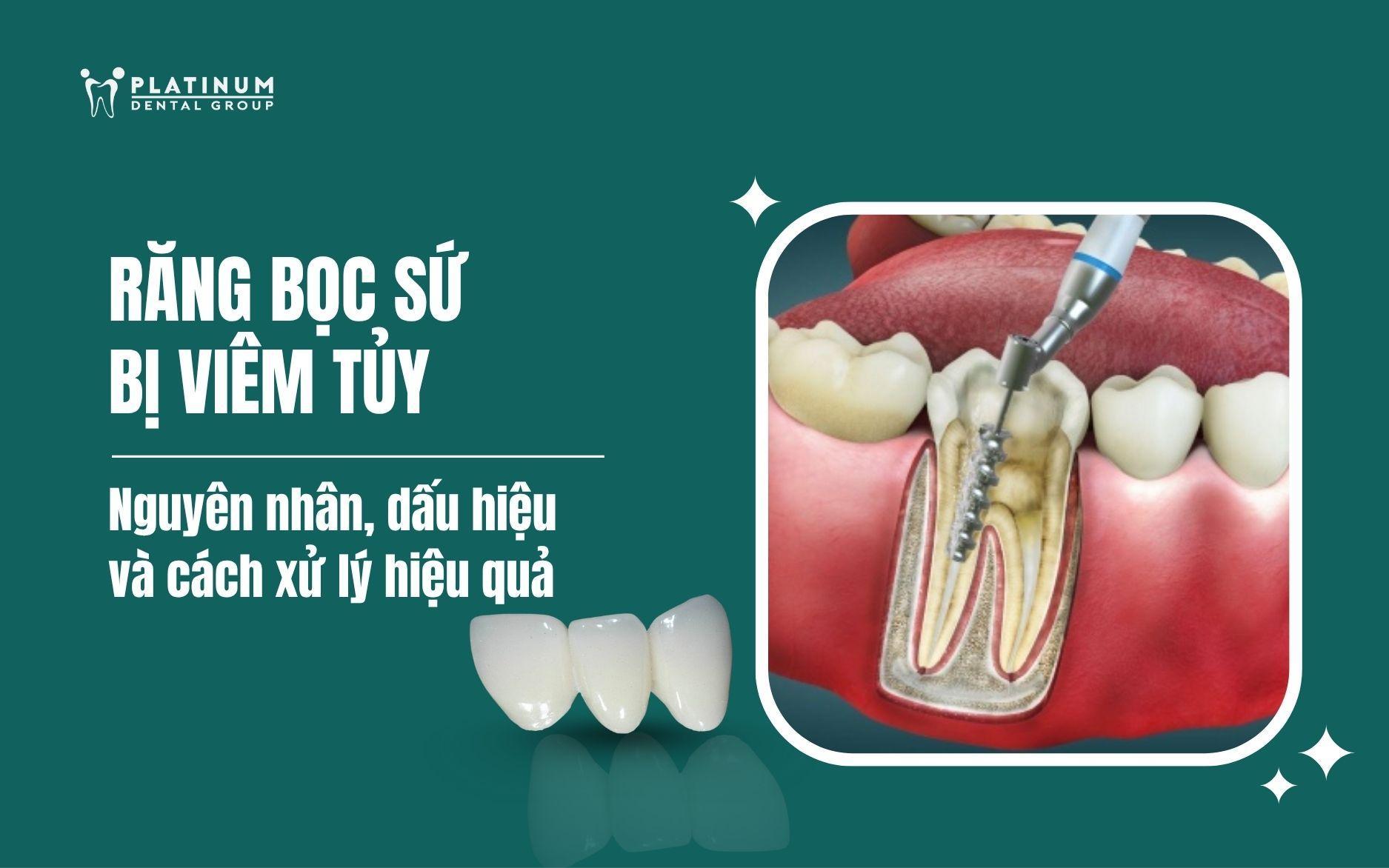 răng bọc sứ bị viêm tủy