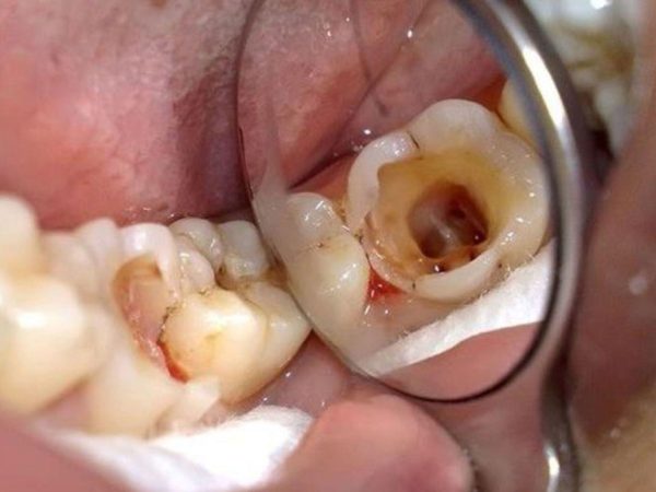 Răng bọc sứ bị viêm tủy: Nguyên nhân, dấu hiệu và cách xử lý hiệu quả 1 Tuỷ bị tổn thương nhưng chưa được điều trị trước khi bọc răng sứ