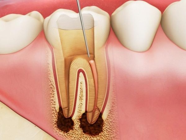 Đau nhức răng sứ lâu năm kéo dài có thể dẫn đến viêm tủy