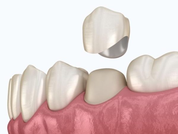 Thay thế bằng răng toàn sứ mới, cao cấp hơn với trường hợp dị ứng với vật liệu chế tác răng sứ