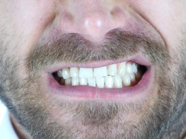 Thói quen nghiến răng có thể làm răng sứ lâu năm đau và ê buốt kéo dài